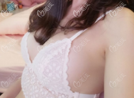 這是第二次脂肪隆胸后的胸部