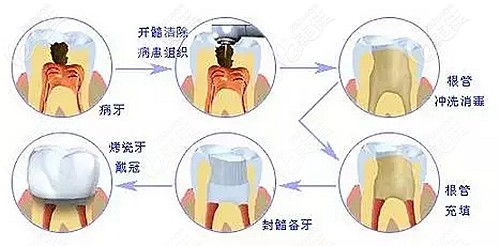 根管治療的步驟