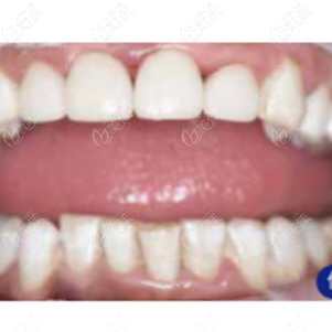 做完全瓷貼面后我的牙齒情況