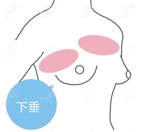 一側(cè)胸下垂一側(cè)胸不下垂 一側(cè)胸下垂一側(cè)胸不下垂