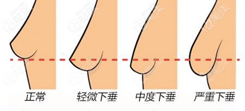 胸下垂的程度決定了手術(shù)方法 胸下垂的程度決定了手術(shù)方法