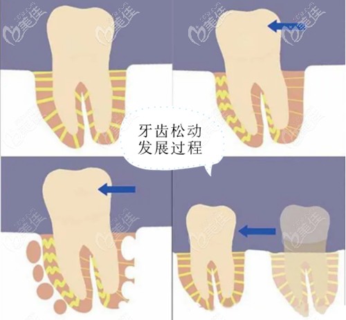 牙周炎導(dǎo)致的牙齒松動發(fā)展過程圖