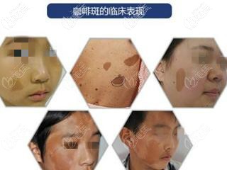 牛奶咖啡斑圖片小孩