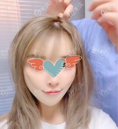 水剝離拉皮除皺真實案例效果