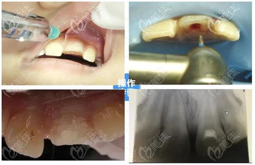 活髓切斷術(shù)治療過程