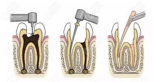 根管治療步驟過程