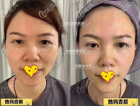 第四代熱瑪吉全面部1200發(fā)效果圖 第四代熱瑪吉全面部1200發(fā)效果圖