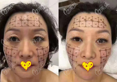 熱瑪吉面部900發(fā)改善法令紋效果圖 熱瑪吉面部900發(fā)改善法令紋效果圖