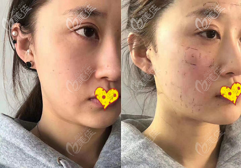 第四代熱瑪吉面部1200發(fā)和900發(fā)改善法令紋效果圖是這樣