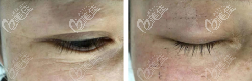 熱瑪吉4代眼周450發(fā)效果圖 熱瑪吉4代眼周450發(fā)效果圖