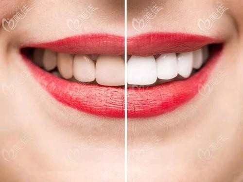 德國vita瓷貼面的價(jià)格