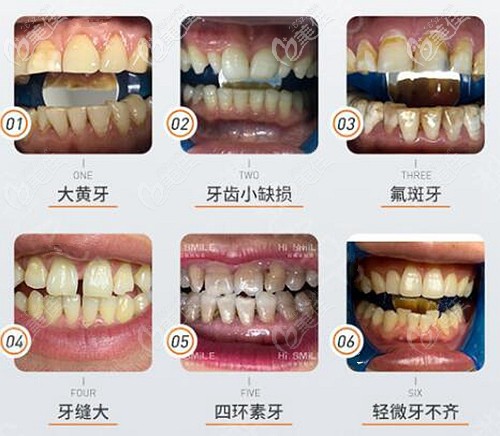 德國vita瓷貼面可以改善的牙齒情況