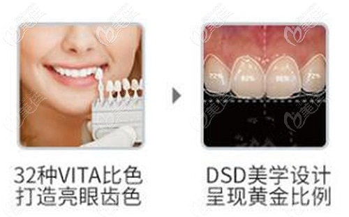 德國vita瓷貼面的優(yōu)勢(shì)