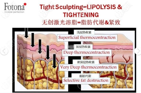 歐洲之星火鳳凰：專業(yè)溶脂設(shè)備