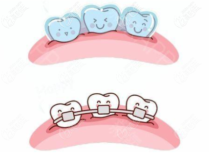 金屬牙套動(dòng)畫(huà)圖示 金屬牙套動(dòng)畫(huà)圖示