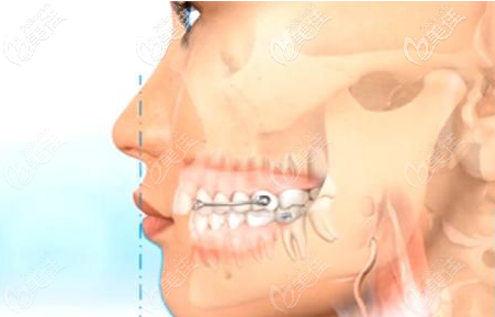 牙齒矯正動(dòng)畫(huà)圖示 牙齒矯正動(dòng)畫(huà)圖示