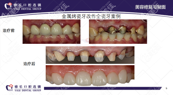 杭州雅樂口腔美白修復(fù)對(duì)比效果