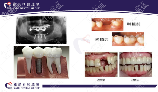 杭州雅樂種植牙案例