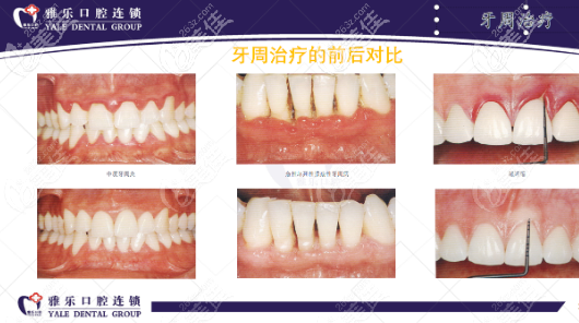 杭州雅樂牙周治療前后對(duì)比