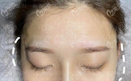 朋友們知道我用了2支潤百顏白紫中分子玻尿酸豐太陽穴后，都來問效果