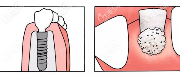 種植牙補骨粉過程