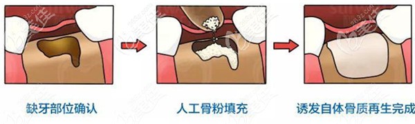 人工骨粉吸收后還可以再次填充