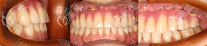  價格僅4萬的韓國伊諾半口種植案例，型號是潛入式和內(nèi)固定兩種