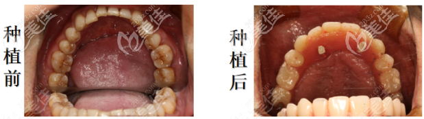種植前后對比照片 種植前后對比照片