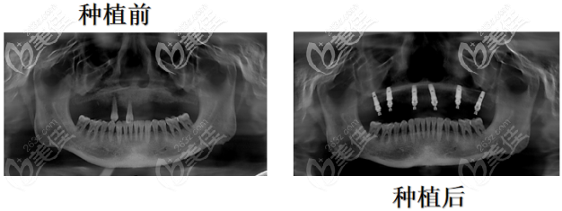 Ct片下的牙部形態(tài) Ct片下的牙部形態(tài)