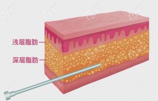 承德美天做面部吸脂過程