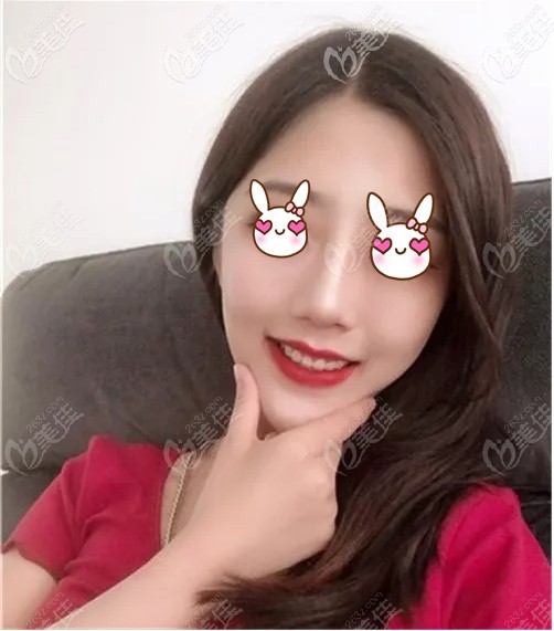 面部吸脂用的局麻，并沒有想象中那么痛，且面頰套僅帶一周即可