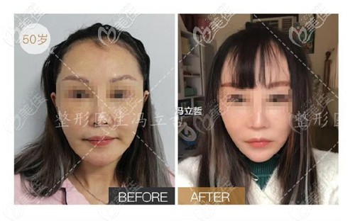 馮立哲面部除皺手術(shù)實例圖