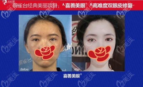 王杰雙眼皮案例