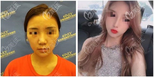 付俊俐醫(yī)生肋骨鼻綜合案例