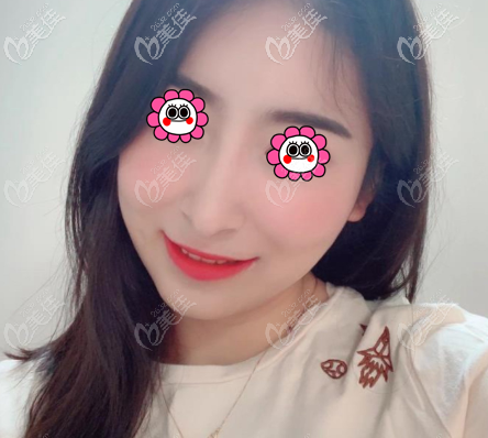 在北京童仁做國產(chǎn)康寧硅膠假體隆鼻2個多月