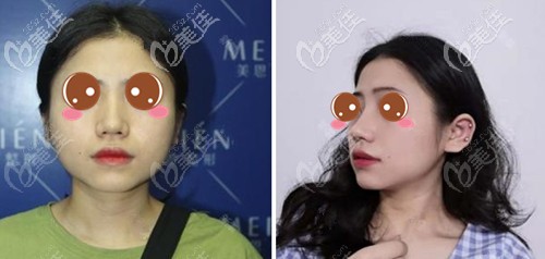 廣州美恩下頜角整形案例