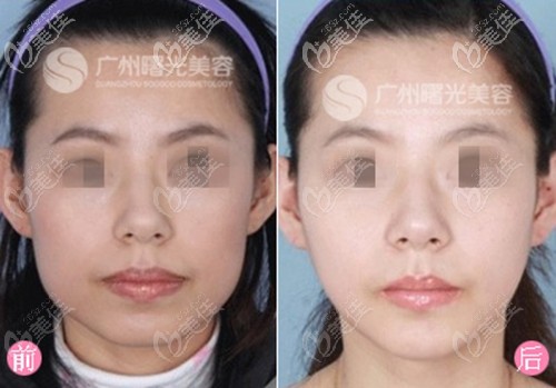 廣州曙光下頜角手術(shù)案例