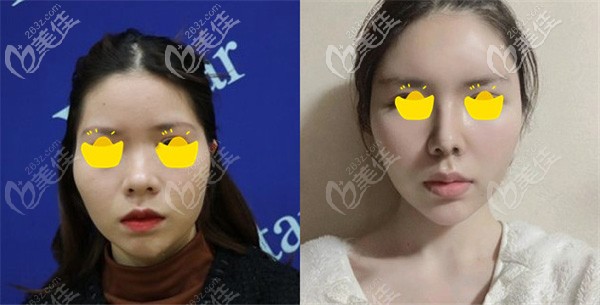 張龍院長做鼻綜合的術前術后對比