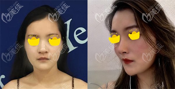 找徐利剛院長做半肋鼻綜合的效果