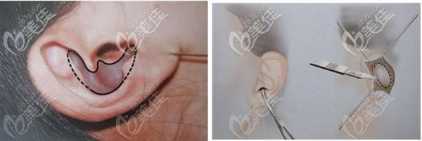 裴彥鵬醫(yī)生做耳軟骨鼻綜合手術