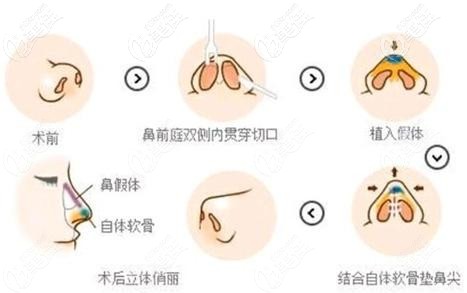 周杰醫(yī)生做耳軟骨鼻綜合手術過程