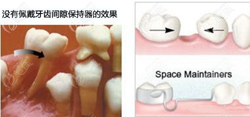 兒童牙齒拔掉戴間隙保持器