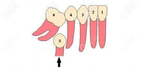 沒戴牙齒間隙保持器的效果