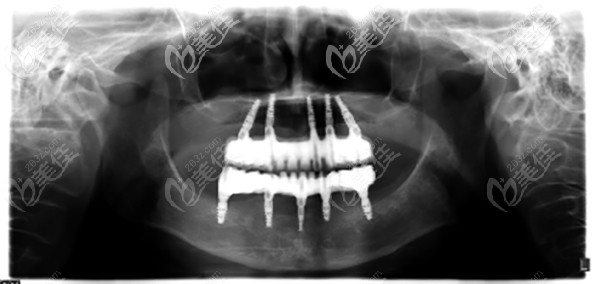 上下各5顆種植體 上下各5顆種植體