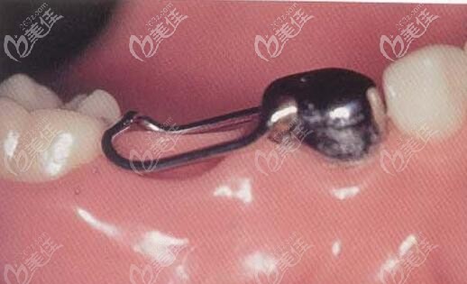 半固定式保持器