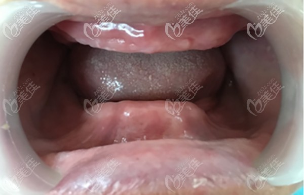 談?wù)?0歲無牙頜老人在杭州美奧口腔做10顆全口種植牙的感受