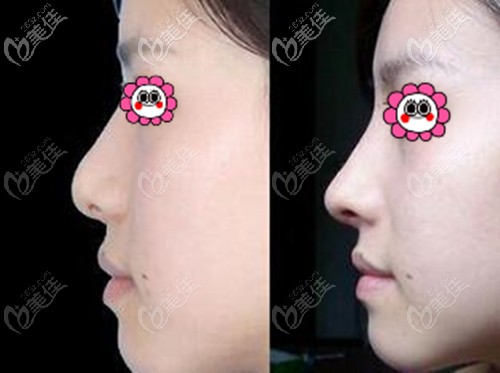 美國旭爾挺隆鼻案例