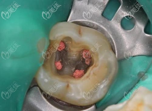 單純用材料已經(jīng)無法恢復(fù)功能