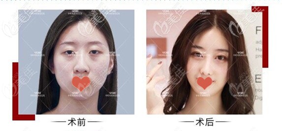 南京華韓奇致肋骨隆鼻案例