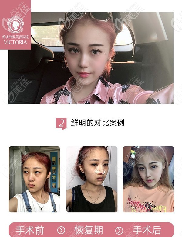 南京維多利亞膨體+肋軟骨案例